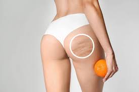 Medicina Estética Corporal 8 Tratamientos Celulitis BERMA